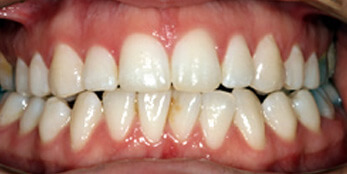 After treatment After treatment