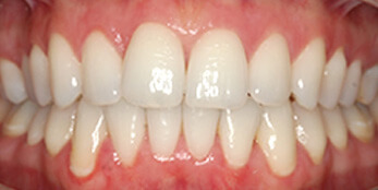After treatment After treatment