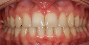 After treatment After treatment
