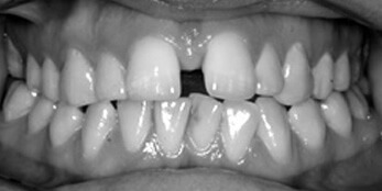 Before treatment Before treatment