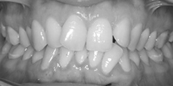 Before treatment Before treatment