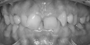 Before treatment Before treatment