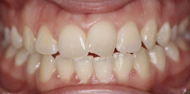 Dental Midlines not matched Dental Midlines not matched
